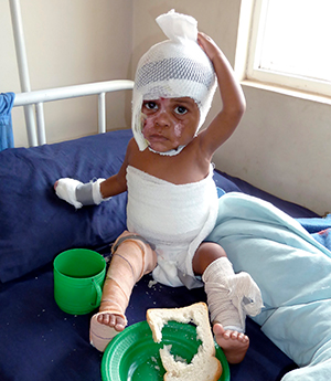 Young burn patient